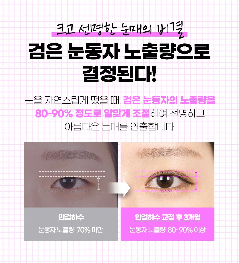 조화로운 비절개눈매교정 하고 싶다면 관련 이미지 2