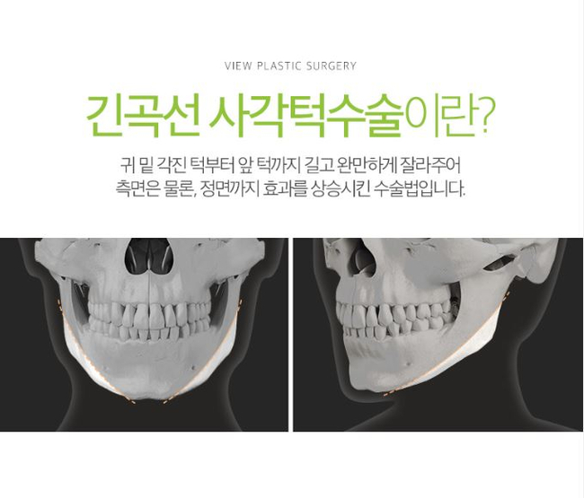 사각턱수술잘하는곳 뷰성형외과 긴곡선사각턱수술로 변화된 모습 관련 이미지 3