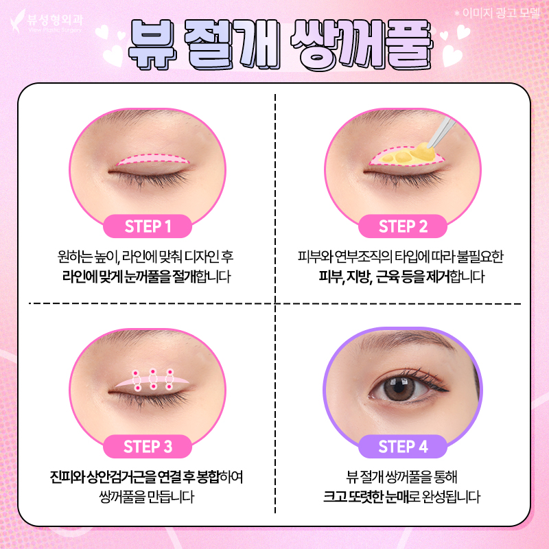 내게 맞는 눈성형 알아보기 관련 이미지 5