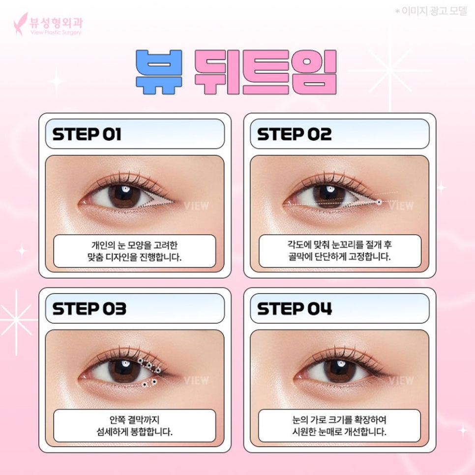 내게 맞는 눈성형 알아보기 관련 이미지 9