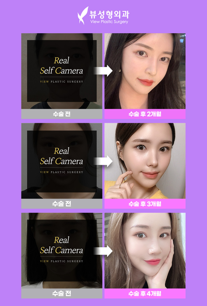 나만의 눈성형을 위한 수술방법 알아보기 관련 이미지 13