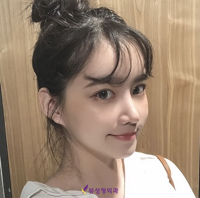 눈매교정으로 또렷하고 매력적인 눈매를 관련 이미지 3