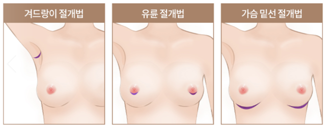 자연스런 가슴성형, 본인에게 적합한 보형물 및 절개방법 선택 중요 관련 이미지 4