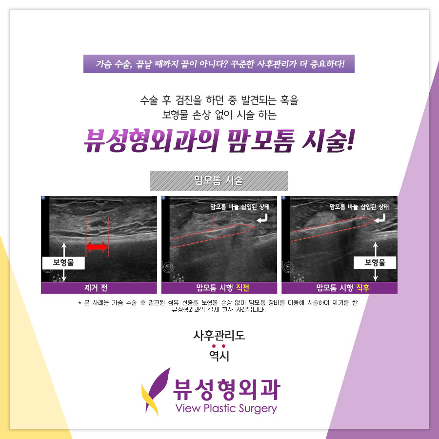 유방검진 맘모톰시술의 중요성! 관련 이미지 5