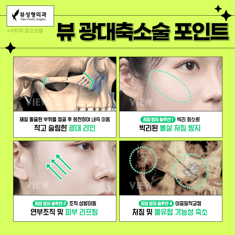 얼굴형의 밸런스를 맞춰주는 안면윤곽수술 관련 이미지 6