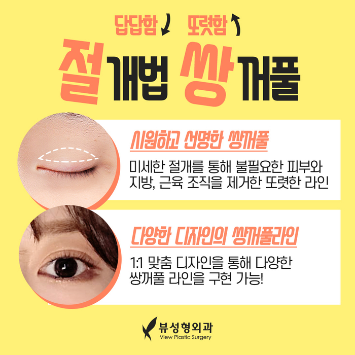 나만의 눈성형을 위한 수술방법 알아보기 관련 이미지 5