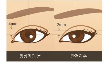 안검하수눈매교정 졸려보이는눈 해결해요 관련 이미지 3