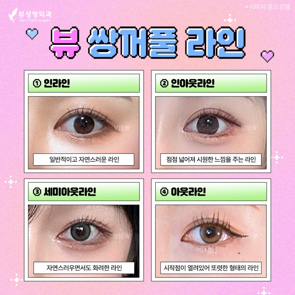 쌍꺼풀 재수술 잘하는 병원은 왜 실패 원인과 라인 복원에 집중할까? 관련 이미지 3