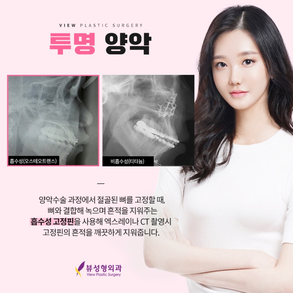 예뻐지는 수술? 양악수술의 올바른 정보 관련 이미지 8