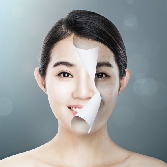 PicoWay Resolve Effects: A Complete Overview from Suitable Candidates to How It Works — Samsung-dong Dermatology Specialist image 2