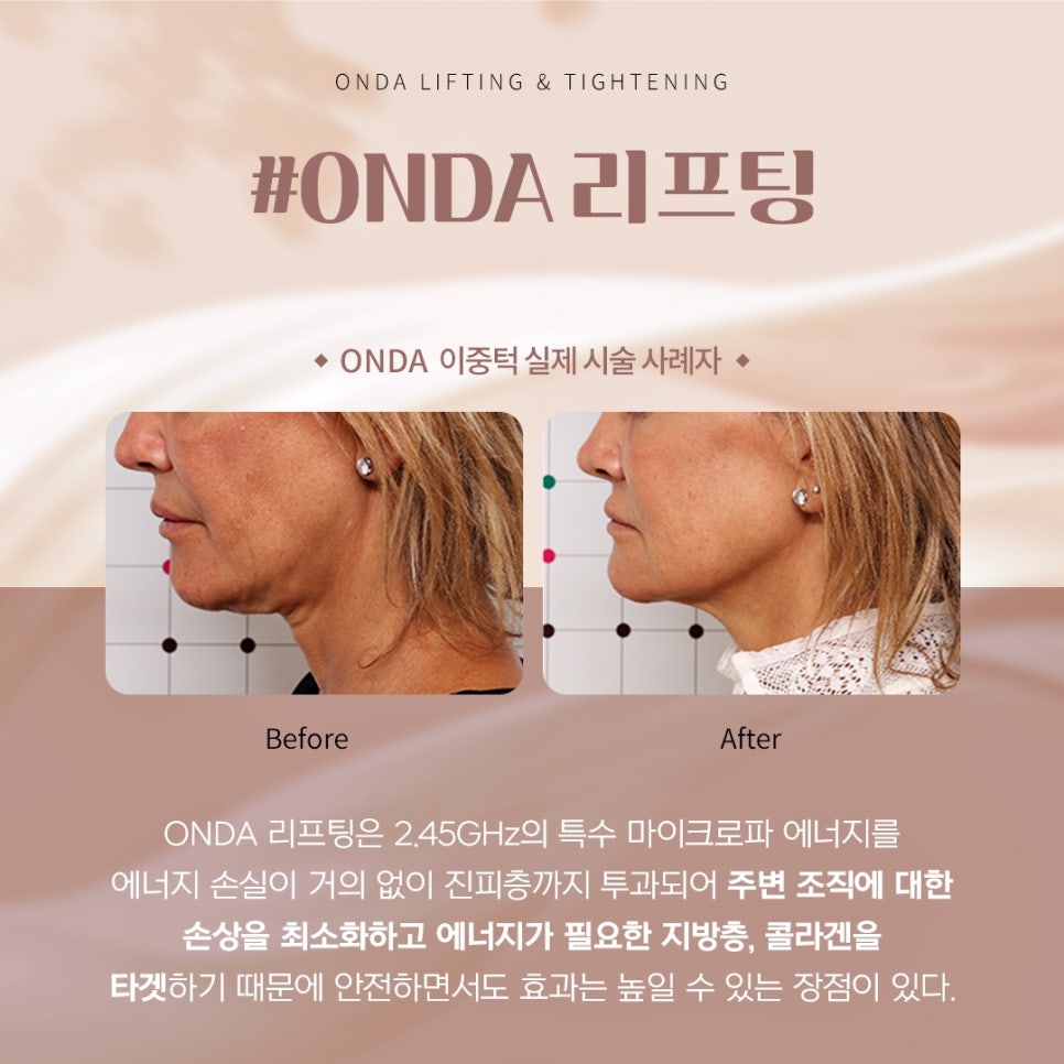 투턱 리프팅, 턱선이 흐려 보일 때 온다리프팅 접근법 - 삼성동 피부과 전문의 관련 이미지 5