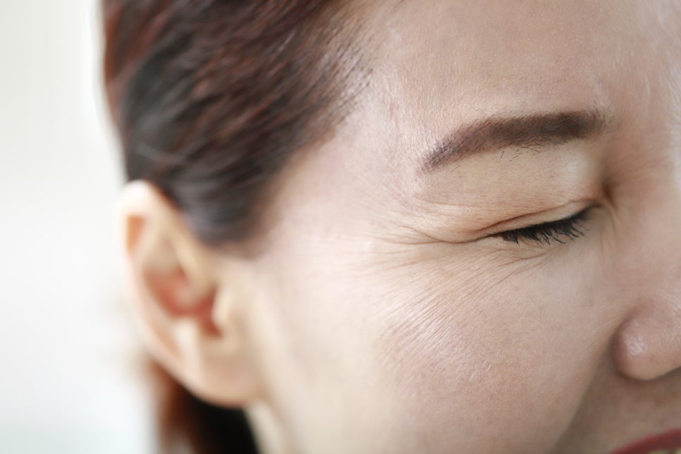 Effects of Botox for Crow’s Feet and Precautions Before Treatment – Dermatology Specialist in Samsung-dong image 2