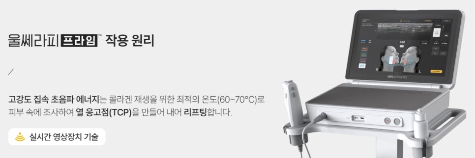 How Long Does Ultherapy PRIME Last? — Samsung-dong Dermatology Specialist image 4