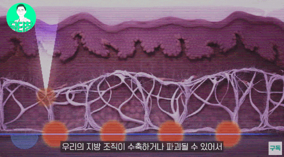 울쎄라 볼꺼짐, 볼패임 현상이 나타나는 이유 - 삼성동 피부과 전문의 관련 이미지 2