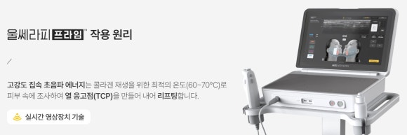 울쎄라프라임 울쎄라 차이, 어떤 점이 달라졌을까요? - 삼성동 피부과 전문의 관련 이미지 5