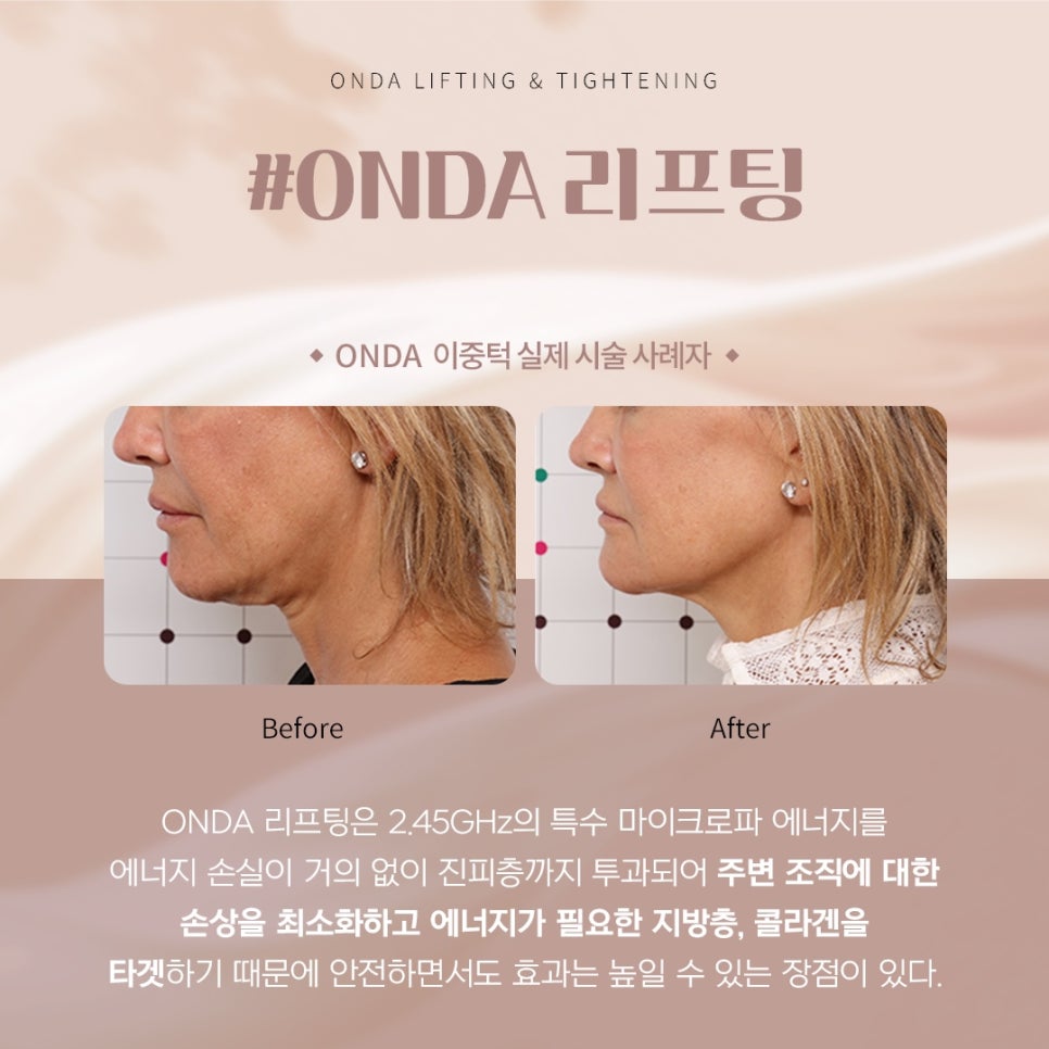 이중턱 없애는법, 매끈한 얼굴 라인을 완성하는 OO리프팅 - 삼성동 피부과 전문의 관련 이미지 4