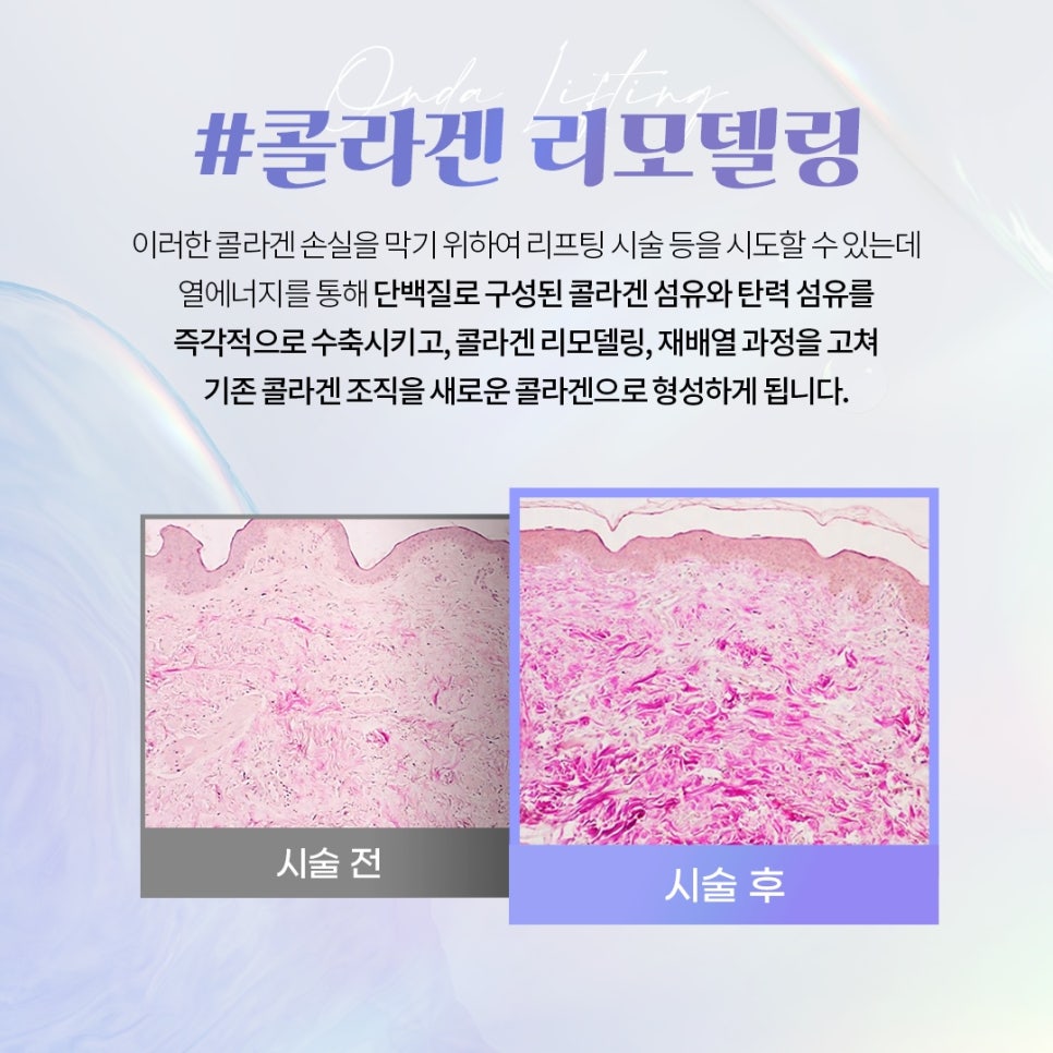 Samseong-dong Onda Lifting Results: How to Naturally Maintain Firmness - A Dermatology Specialist in Samseong-dong image 3