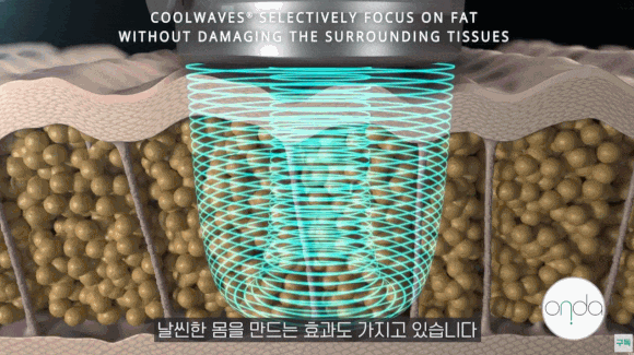 창피부과 피부 탄력 증가, 지방 감소에 효과적인 관련 이미지 3