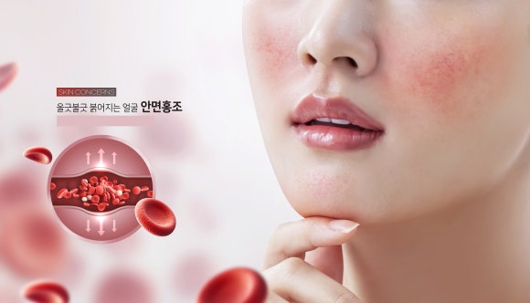 리쥬란병원, 홍조 원인을 알면 개선할 수 있습니다 - 삼성동 피부과 전문의 관련 이미지 1