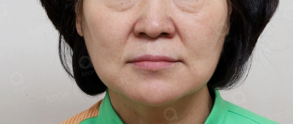 중년리프팅, 눈 밑 불룩한 고랑, 깊은 팔자주름 및 하안면부 처짐 수술 사례 관련 이미지 3