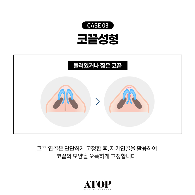 비중격연골 코끝수술 장단점, 의료진의 연골 선택 기준 관련 이미지 6