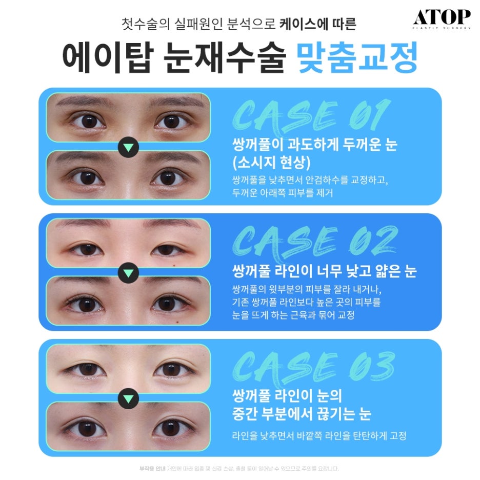 Double Eyelid Revision Surgery, My Own Money, Final Eye Plastic Surgery image 2