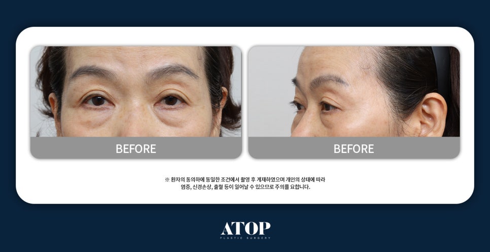 중년 하안검수술 눈밑 주름과 지방 제거에 대한 의료진 설명 관련 이미지 4