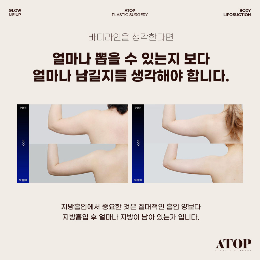 팔뚝지방흡입, 지방을 많이 빼는 것보다 중요한 건 매끄러운 라인 관련 이미지 6
