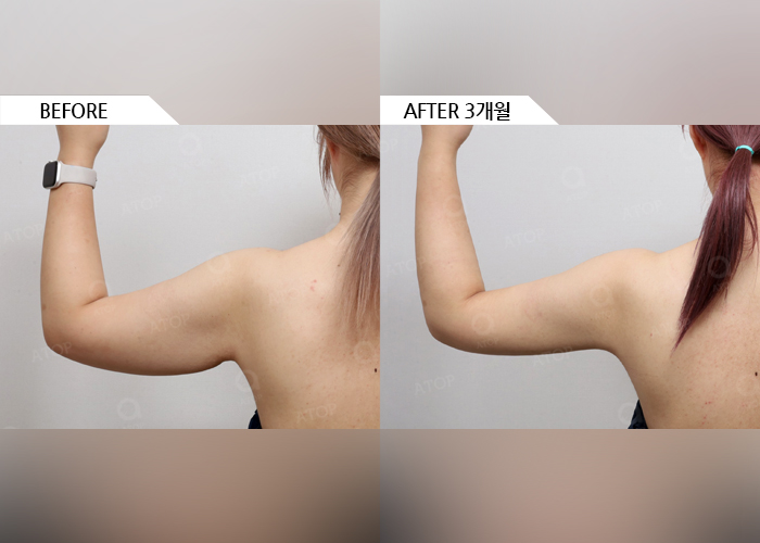 팔뚝지방흡입, 지방을 많이 빼는 것보다 중요한 건 매끄러운 라인 관련 이미지 2