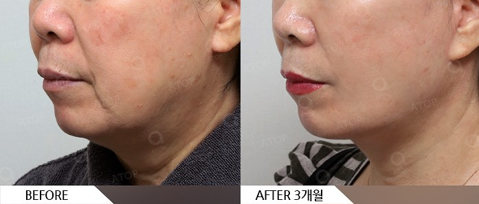 Mini Facelift Lifting That Also Improves Nasolabial Folds: Upgraded Yeo-woo Lifting image 6