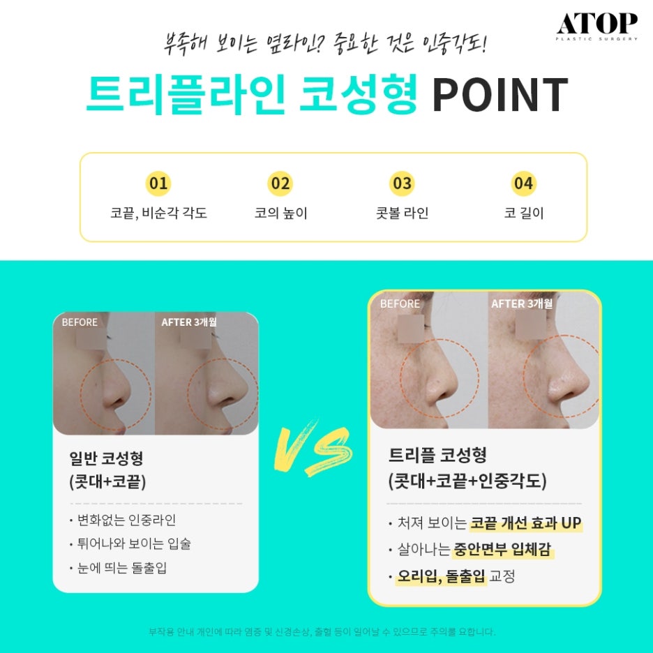 매부리코성형후기 차이나는 이유 관련 이미지 3