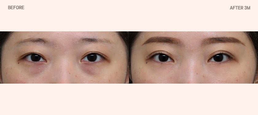 Is Lower Eyelid Fat Repositioning Surgery Simply About Removing Fat? image 4