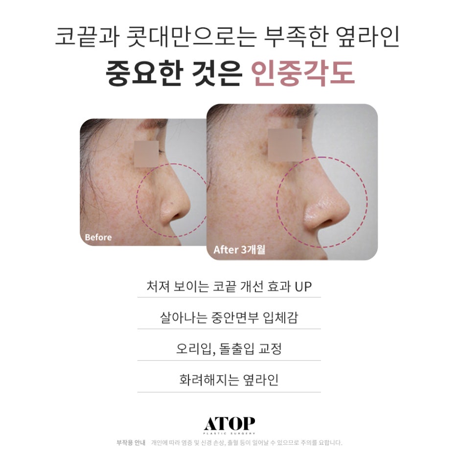 코끝성형비용 제대로 알고 계획해야 관련 이미지 3