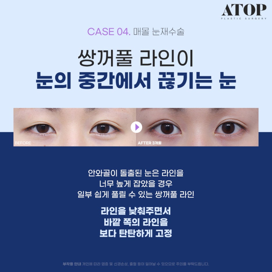 Where to Get Revision Eyelid Surgery Done Well: Surgical Methods Tailored to Eye Type image 5