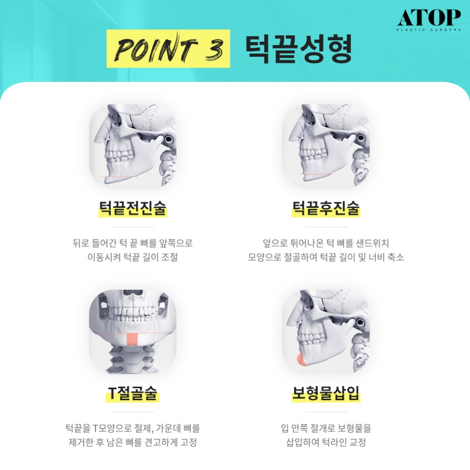 광대축소후기 크고 울퉁불퉁한 얼굴형 개선 관련 이미지 5