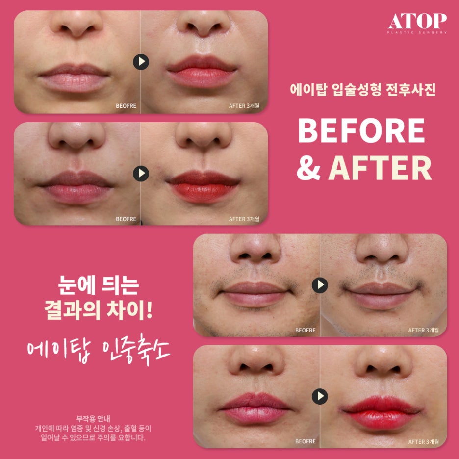 Midface Reduction: Improving Both the Inner and Outer Philtrum Together image 7