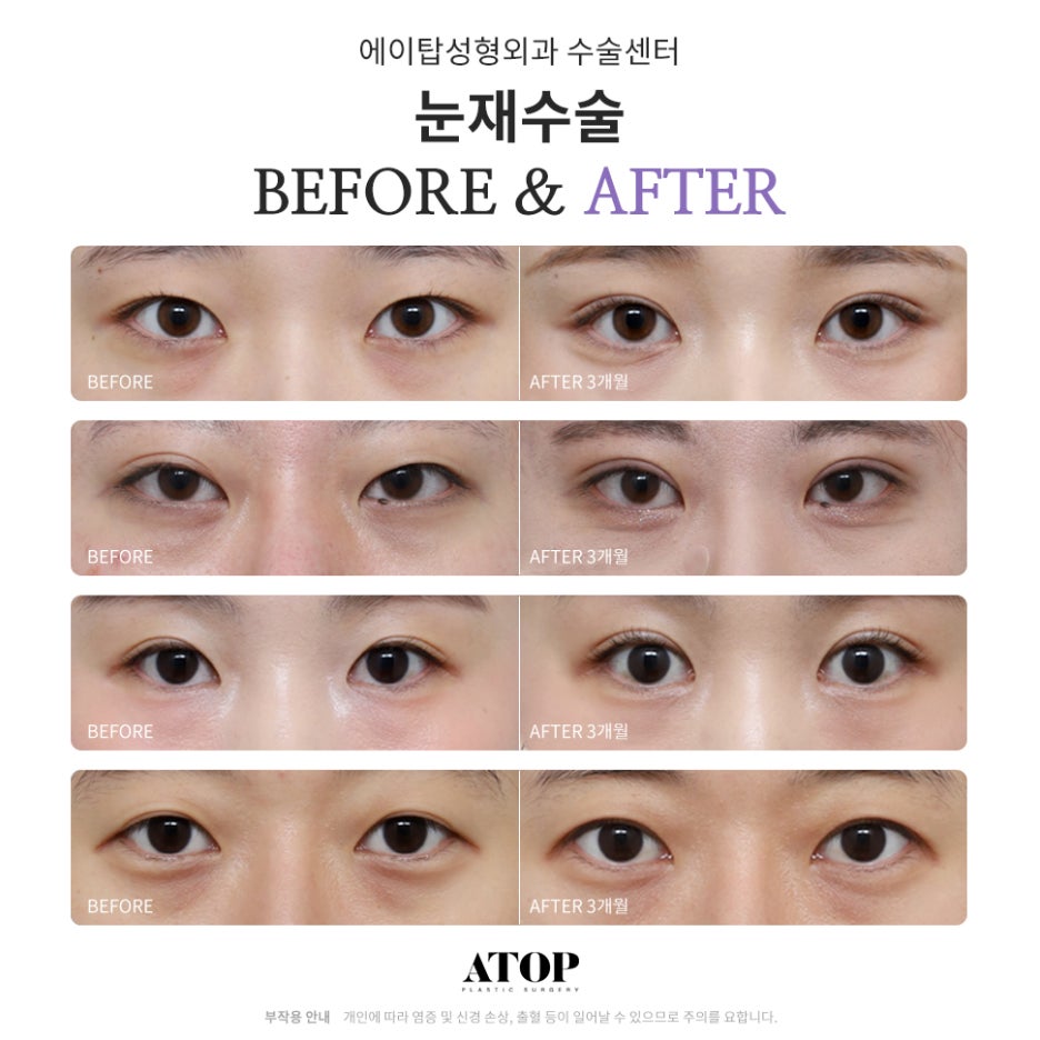 쌍수재수술가격 자연스러운 눈으로 관련 이미지 7