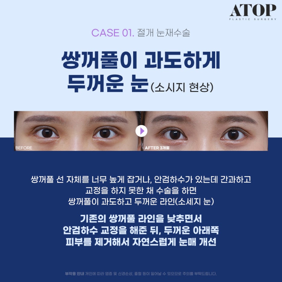 Where to Get Revision Eyelid Surgery Done Well: Surgical Methods Tailored to Eye Type image 2