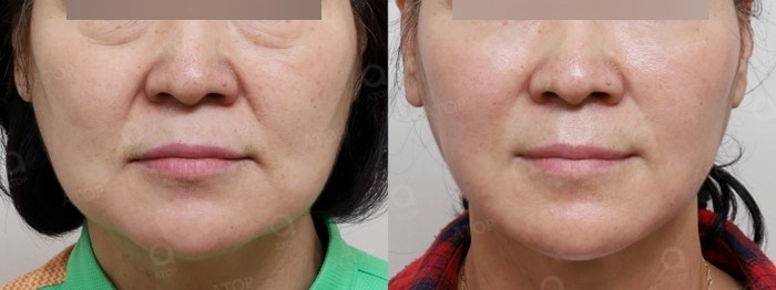 중년리프팅, 눈 밑 불룩한 고랑, 깊은 팔자주름 및 하안면부 처짐 수술 사례 관련 이미지 5