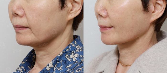 Facial rejuvenation surgery in the 60s [deep plane facelift revision] - A case of improving nasolabial folds, the midface, and jowls image 8