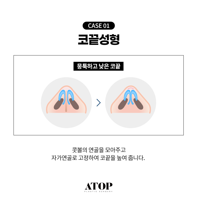 비중격연골 코끝수술 장단점, 의료진의 연골 선택 기준 관련 이미지 4