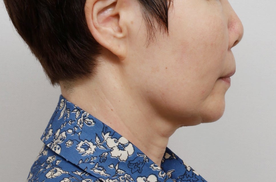 Facial rejuvenation surgery in the 60s [deep plane facelift revision] - A case of improving nasolabial folds, the midface, and jowls image 3