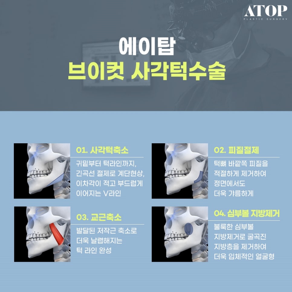 남자사각턱수술 중점적으로 봐야 하는 점 관련 이미지 2