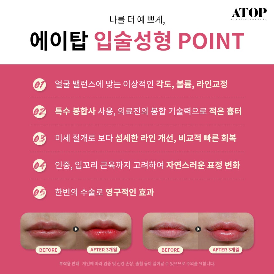 입꼬리수술잘하는곳 러블리한 입매가 될 수 있게 관련 이미지 3