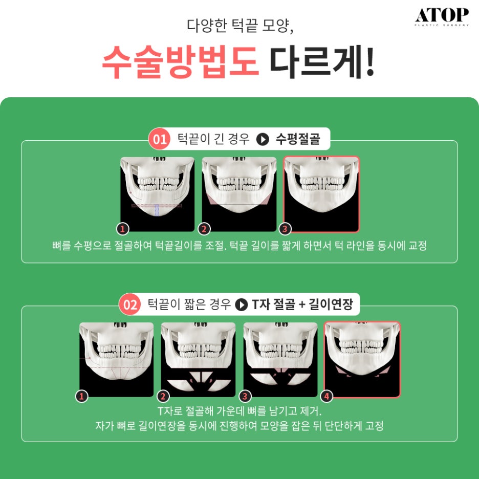 Genioplasty with a Plan Suited to My Chin Shape image 3