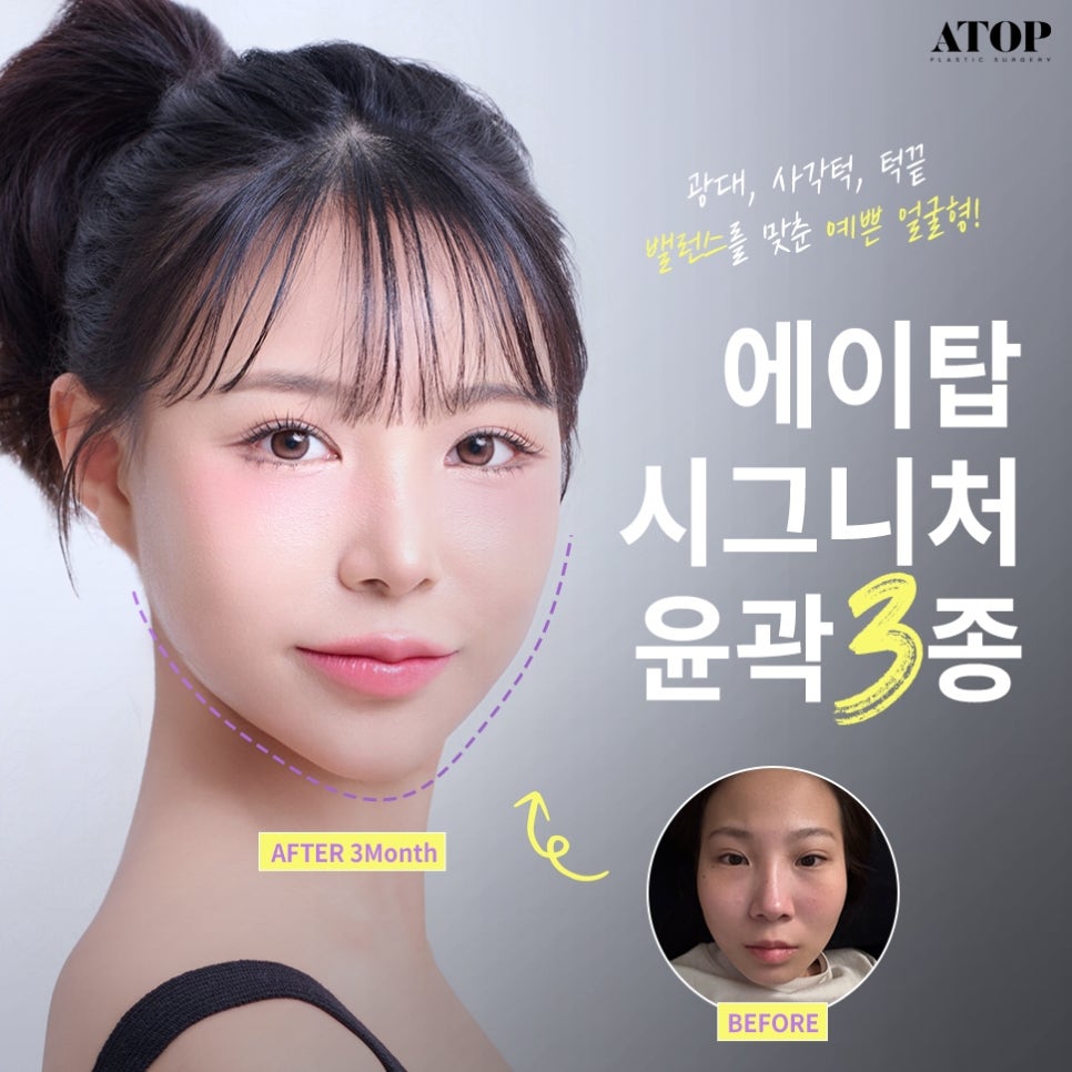Gangnam Facial Contouring 3-in-1: A Soft, Smooth Line image 1