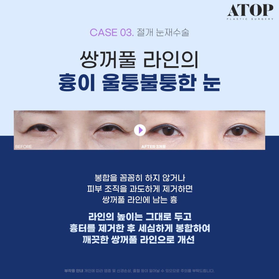 Where to Get Revision Eyelid Surgery Done Well: Surgical Methods Tailored to Eye Type image 4