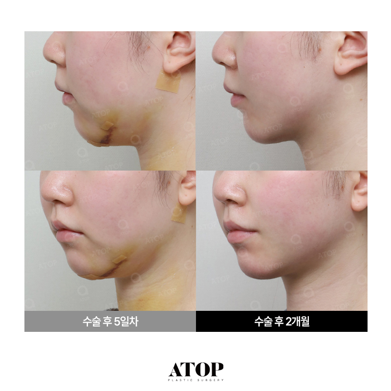 얼굴지방흡입 전후 차이, 라인 도드라지는 시기는? 관련 이미지 5