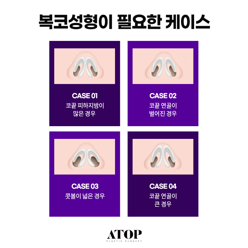 콧볼축소수술방법 원인을 먼저 파악해야 하는 이유 관련 이미지 2