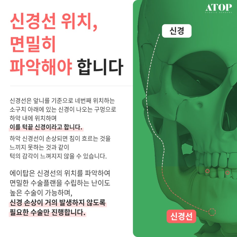 Genioplasty with a Plan Suited to My Chin Shape image 2